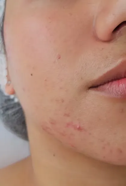 Antes de limpieza facial profunda